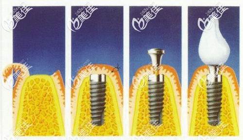 傳統(tǒng)種植牙過(guò)程 傳統(tǒng)種植牙過(guò)程