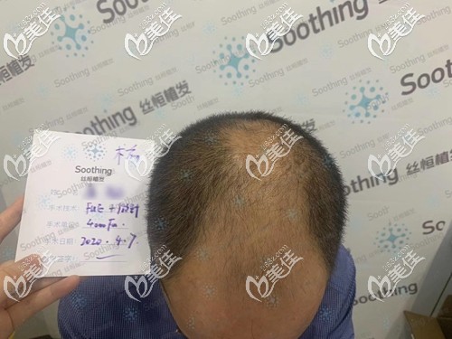 4000個(gè)毛囊能植發(fā)多大面積 4000個(gè)毛囊能植發(fā)多大面積