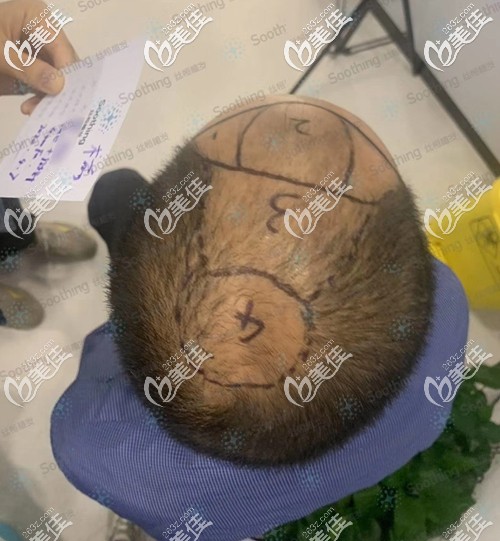 植發(fā)前設(shè)計(jì)了種植方案 植發(fā)前設(shè)計(jì)了種植方案