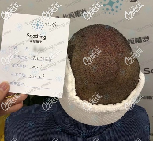 5級(jí)脫發(fā)植發(fā)4000單位即刻<span style= 5級(jí)脫發(fā)植發(fā)4000單位即刻<span style=