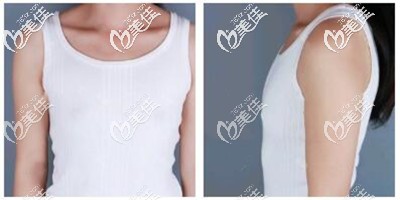 假體隆胸手術(shù)前 假體隆胸手術(shù)前