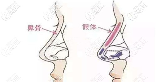 楊哲醫(yī)師做硅膠假體隆鼻手術(shù) 楊哲醫(yī)師做硅膠假體隆鼻手術(shù)