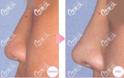 耳軟骨隆鼻后的效果對比 耳軟骨隆鼻后的效果對比