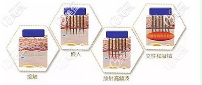 黃金微針去痘坑的優(yōu)勢