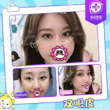 從雙眼皮案例來看深圳非凡易培金技術(shù)怎么樣 從雙眼皮案例來看深圳非凡易培金技術(shù)怎么樣