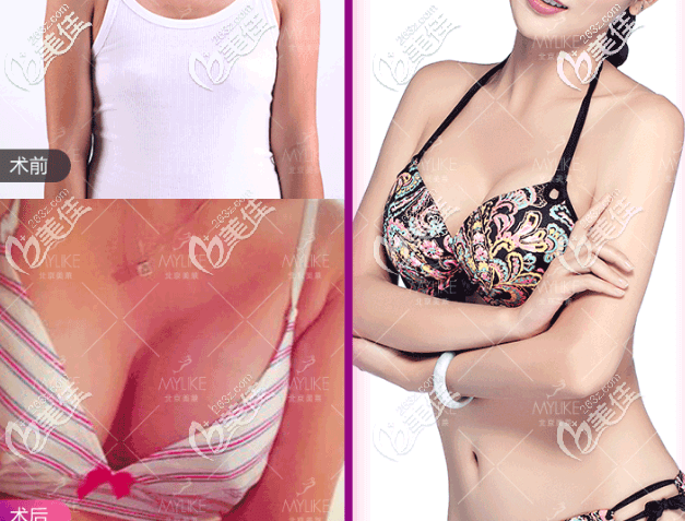 北京美萊董巖巖傲諾拉閃耀假體隆胸案例