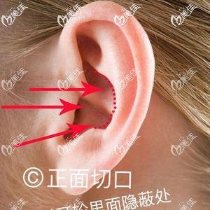 自體耳軟骨正面?。簭膶?duì)耳輪的隱蔽處作切口取