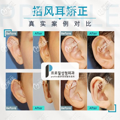 招風(fēng)耳前后對比案例 招風(fēng)耳前后對比案例