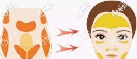 自體脂肪面部填充 自體脂肪面部填充