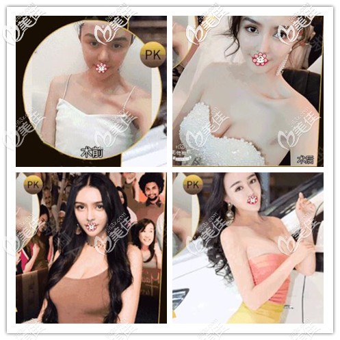 成都美錠美250cc假體隆胸案例