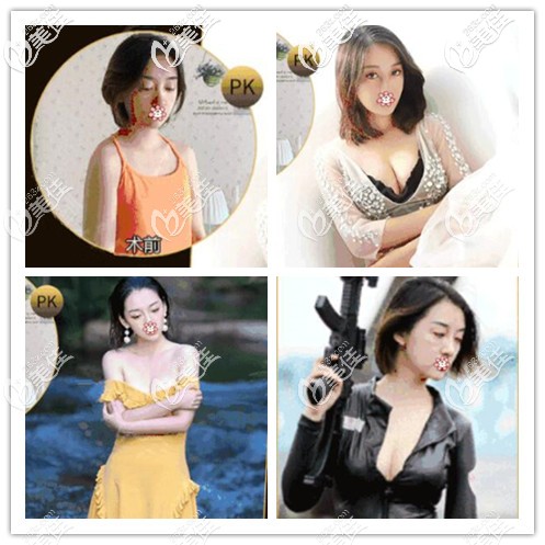 何一波270cc假體隆胸案例效果