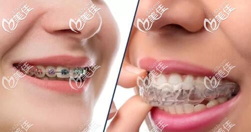 牙齒矯治器 牙齒矯治器