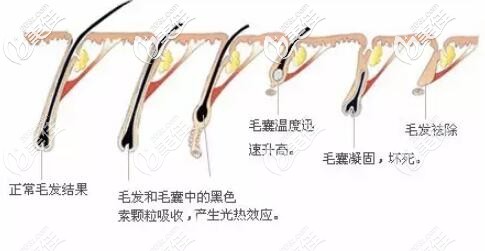 激光脫胡子過程原理圖 激光脫胡子過程原理圖