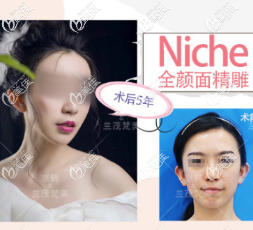 喬愛軍19萬的面部脂肪填充案例