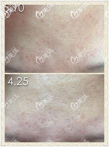 黃金微針去痘坑痘印后的效果