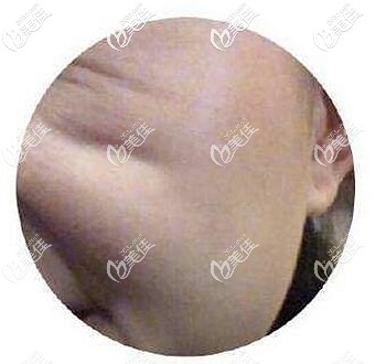 動(dòng)態(tài)印第安紋的改善方法