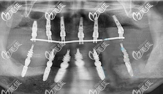 我在沈陽(yáng)米蘭口腔做全口種植牙后的CT片 我在沈陽(yáng)米蘭口腔做全口種植牙后的CT片