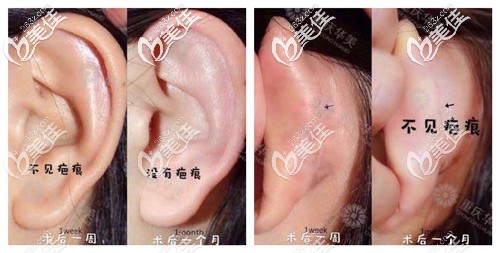 耳軟骨取出隆鼻切口疤痕情況