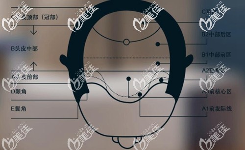 不同的脫發(fā)部位采取個性化種植 不同的脫發(fā)部位采取個性化種植