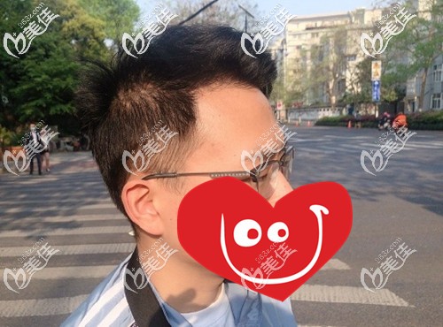 我多年雄脫造成額角光禿、頭頂大面積稀疏，經(jīng)BHT2.0大面積植發(fā)+稀疏加密后變這樣...