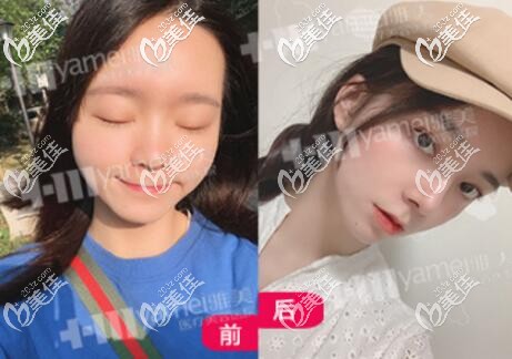在長沙雅美做眼鼻綜合整形術(shù)前術(shù)后對比照 在長沙雅美做眼鼻綜合整形術(shù)前術(shù)后對比照