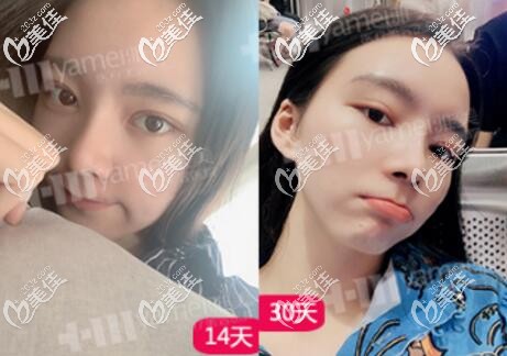 做眼鼻整形一個月內(nèi)的變化效果照 做眼鼻整形一個月內(nèi)的變化效果照