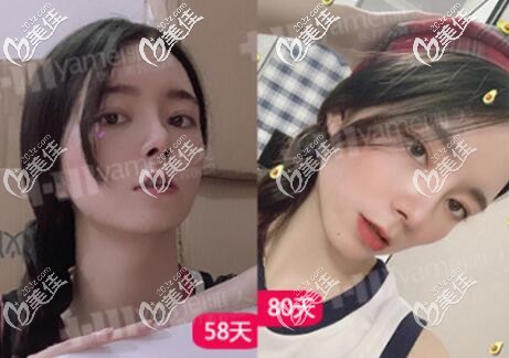 在長沙做眼鼻整形2個月左右的變化效果照 在長沙做眼鼻整形2個月左右的變化效果照