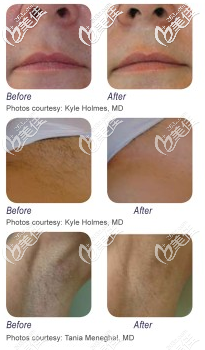 華爾茲冰點脫毛