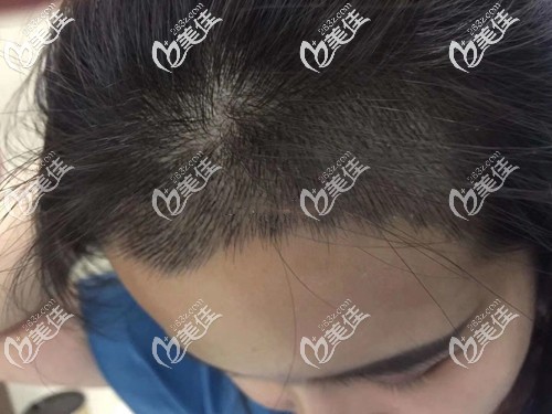 女士發(fā)際線種植2000單位效果圖 女士發(fā)際線種植2000單位效果圖
