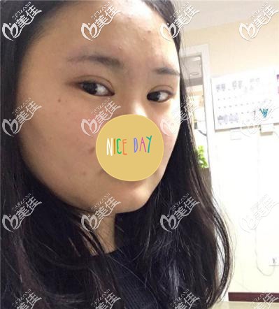 面部吸脂術(shù)前有明顯雙下巴 面部吸脂術(shù)前有明顯雙下巴