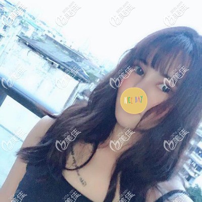 臉上脂肪多不但臉大雙下巴都出來了！輕松瘦臉我選擇AIS面部吸脂