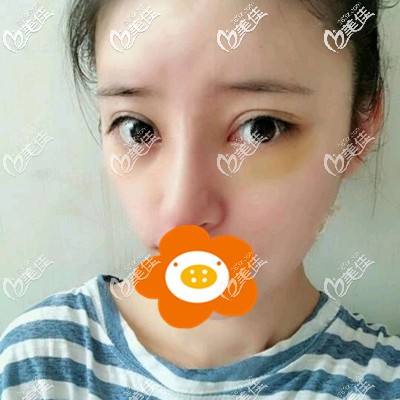 術后一周拆線還有點腫