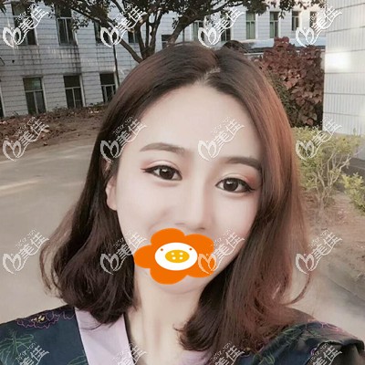 硅膠假體加耳軟骨綜合隆鼻花4萬(wàn)貴不貴?親們看我的恢復(fù)圖來(lái)評(píng)價(jià)下.....