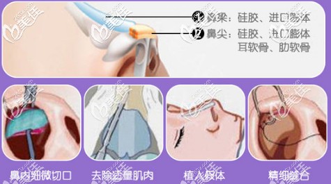 何靜醫(yī)生擅長做GMR美鼻術