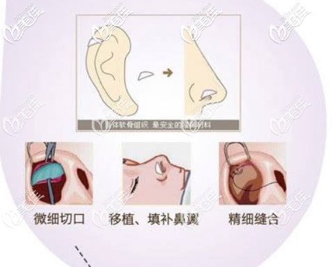 鼻翼缺損再造圖片 鼻翼缺損再造圖片