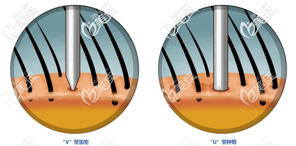 雍禾的lattice點陣加密頭發(fā)種植技術(shù)