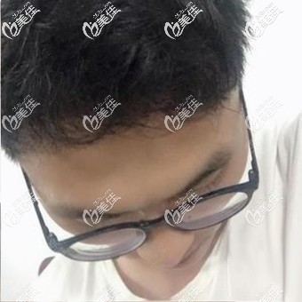 在做發(fā)際線種植前我先打聽了貴陽(yáng)口碑好的植發(fā)醫(yī)院,提前打醫(yī)院電話預(yù)約后才去的