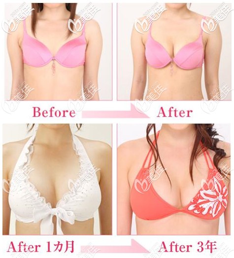 島倉康人隆胸對比案例