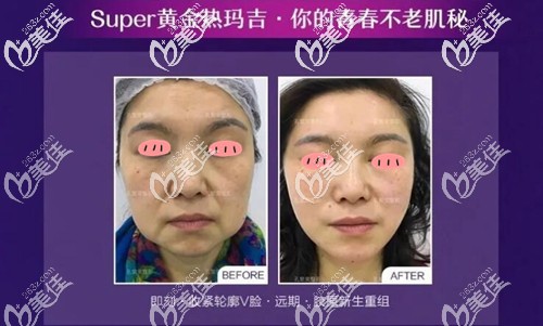 黃金熱瑪吉面部治療療效圖