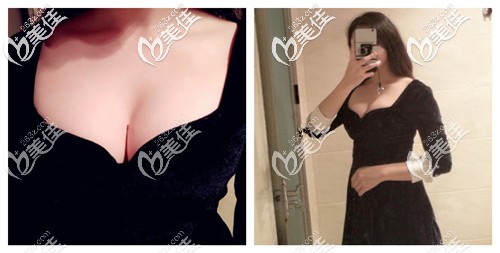 說(shuō)70a胸部偏瘦做自體脂肪隆胸手術(shù)沒(méi)效果的來(lái)看我術(shù)后半年胸部的變化