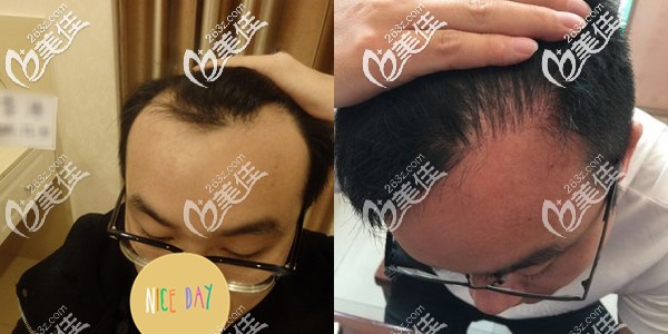 北京碧蓮盛袁國安發(fā)際線種植效果圖 北京碧蓮盛袁國安發(fā)際線種植效果圖