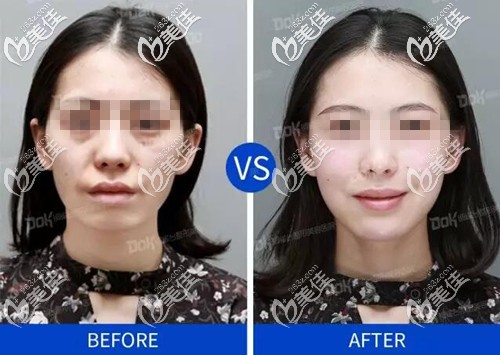 豐下巴前后對比案例 豐下巴前后對比案例
