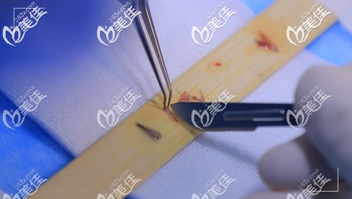 手術(shù)精細(xì)毛囊細(xì)微分離 手術(shù)精細(xì)毛囊細(xì)微分離