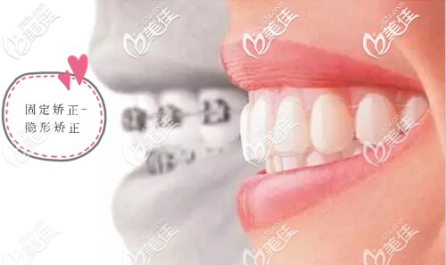 譚杰醫(yī)生擅長青少年及成人錯頜畸形矯治 譚杰醫(yī)生擅長青少年及成人錯頜畸形矯治