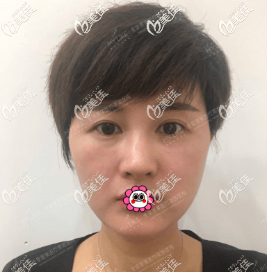 我的面部埋線提升親身經(jīng)歷告訴你為什么我不后悔