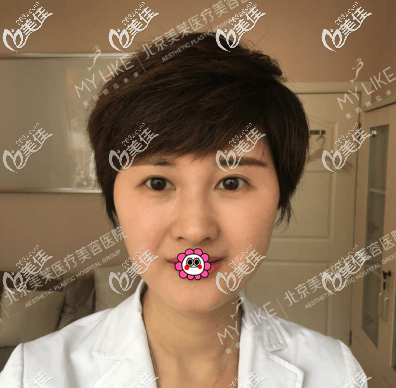 面部埋線提升一個多月的效果