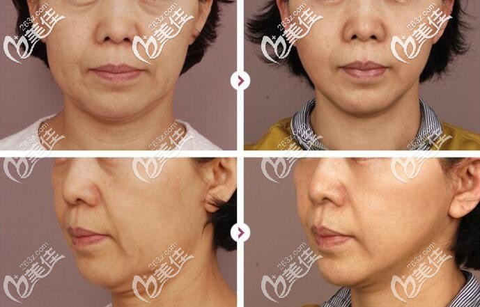 第五代熱瑪吉治療案例 第五代熱瑪吉治療案例