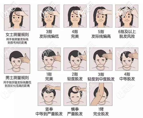 發(fā)際線脫發(fā)等級自測圖 發(fā)際線脫發(fā)等級自測圖