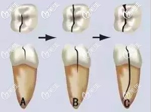 牙隱裂的從淺表到牙根的發(fā)展圖