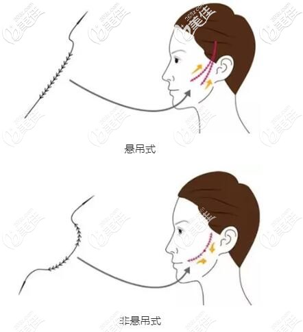 大V埋線提升分為懸吊式和非懸吊式 大V埋線提升分為懸吊式和非懸吊式